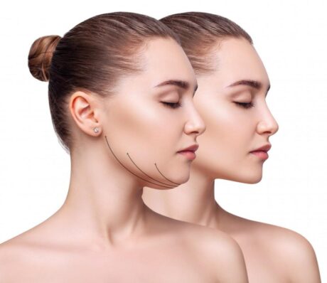 Kybella Double Chin Reduction (Platinum)