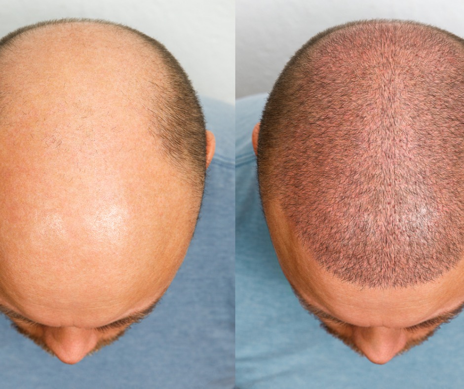 Neografts Hair Transplant in Multan, Pakistan