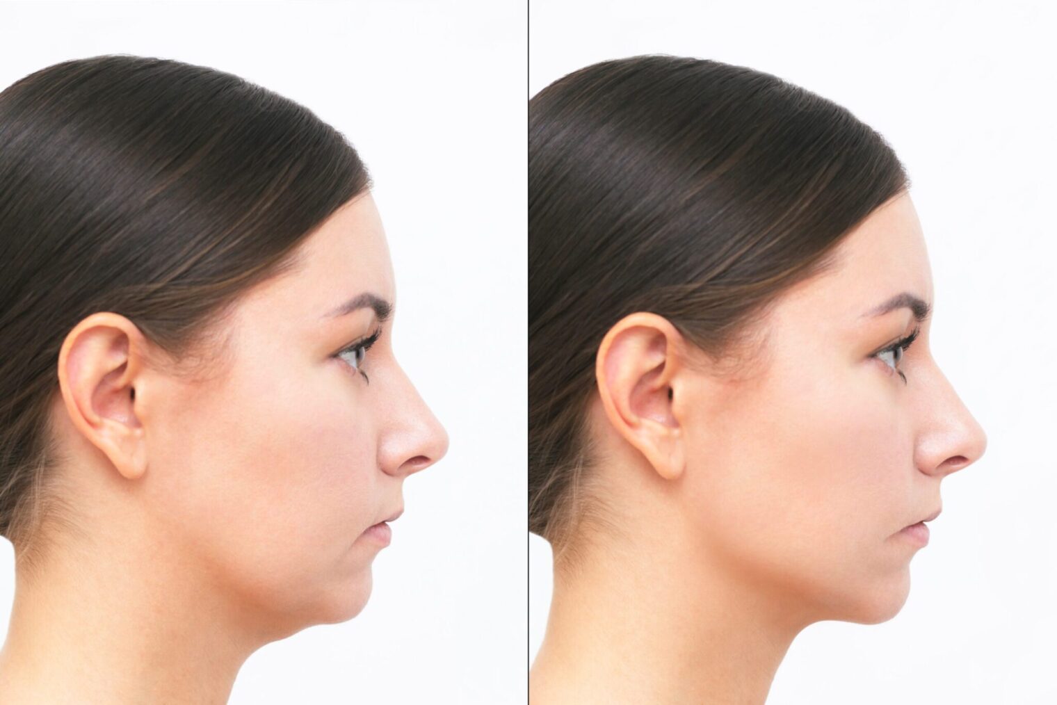 Fat Melting Injections in Islamabad, Pakistan: Do You Want Results?